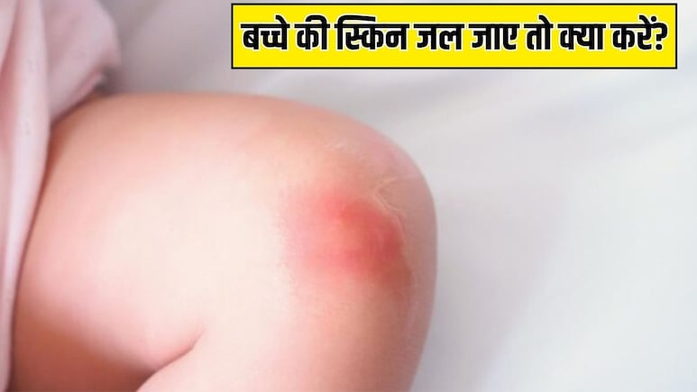 बच्चे पर गर्म पानी, दूध या कोई गर्म चीज गिर जाए, तो सबसे पहले क्या करें? Parenting Expert ने बताया