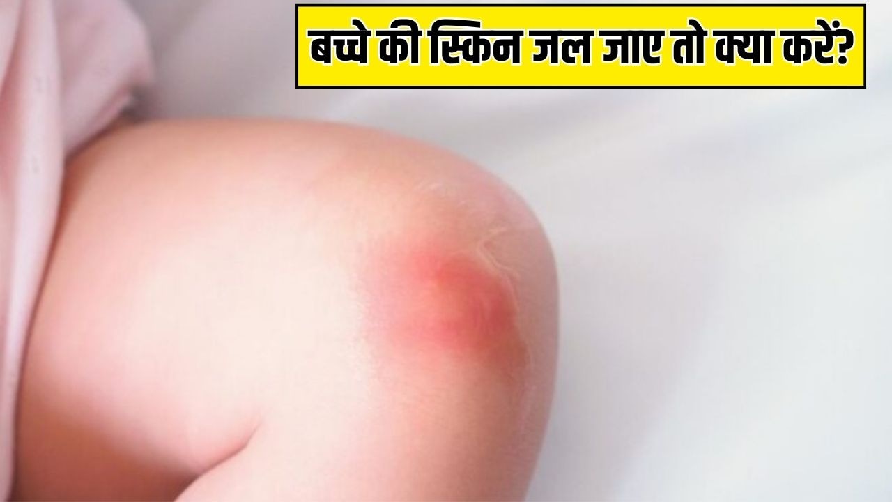बच्चे पर गर्म पानी, दूध या कोई गर्म चीज गिर जाए, तो सबसे पहले क्या करें? Parenting Expert ने बताया