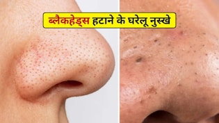 चेहरे के ब्लैकहेड्स कैसे साफ करें? नाक, ठुड्डी और माथे पर ब्लैकहेड्स हटाने के आसान तरीके