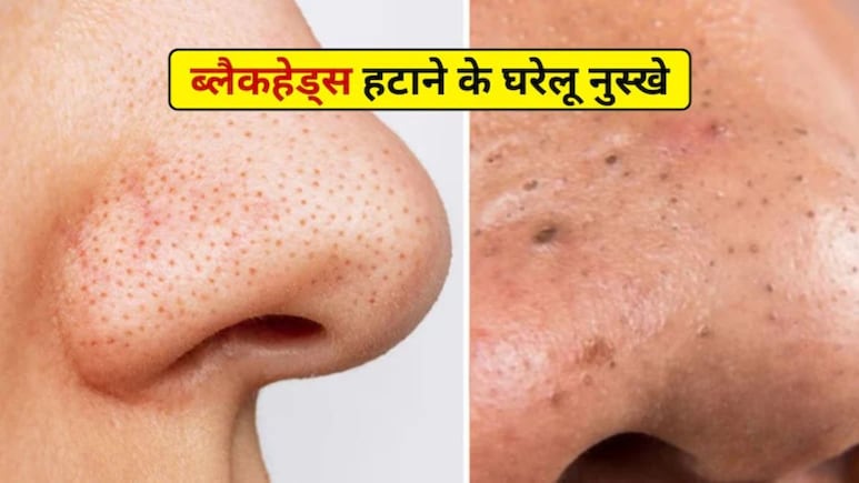 चेहरे के ब्लैकहेड्स कैसे साफ करें? नाक, ठुड्डी और माथे पर ब्लैकहेड्स हटाने के आसान तरीके