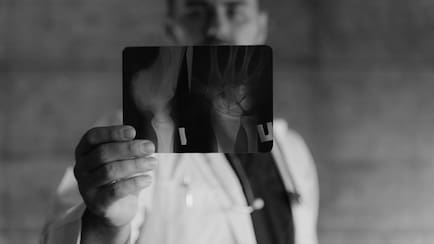 Osteoporosis Is Emerging Earlier: How Young Adults Can Protect Bone Health