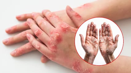 फटे हाथों को कैसे ठीक करें? मॉइस्चराइजर लगाते समय इन बातों का रखें ध्यान