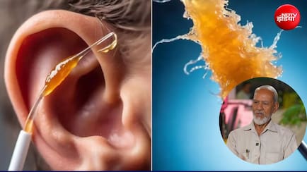 कान का मैल कैसे साफ करें? यूनानी डॉक्टर ने बताए सुरक्षित घरेलू उपाय