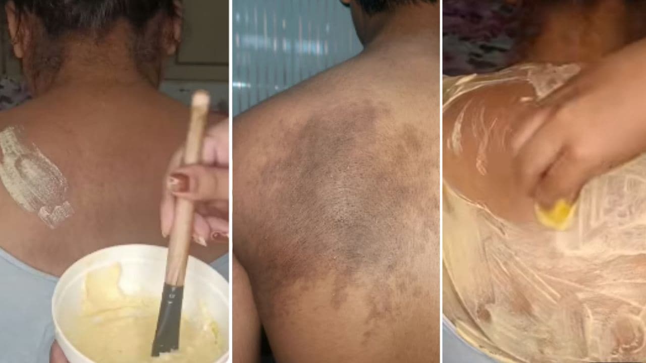 पीठ पर दाने कैसे ठीक करें? कमर पर काले दाग के निशान साफ करने के आसान तरीके