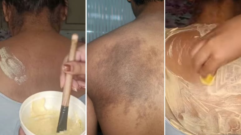 पीठ पर दाने कैसे ठीक करें? कमर पर काले दाग के निशान साफ करने के आसान तरीके