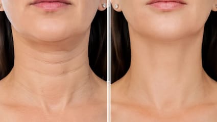 गर्दन पर लाइनें दिखती हैं? स्किन एक्सपर्ट ने बताया ढीली पड़ती स्किन को टाइट करने का तरीका