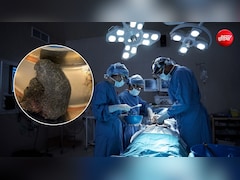 9 साल की बच्ची के पेट से निकला 1 किलो बालों का गुच्छा, रेपुंजेल सिंड्रोम ने डॉक्टर को किया हैरान
