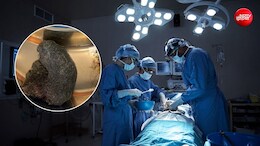 9 साल की बच्ची के पेट से निकला 1 किलो बालों का गुच्छा, रेपुंजेल सिंड्रोम ने डॉक्टर को किया हैरान