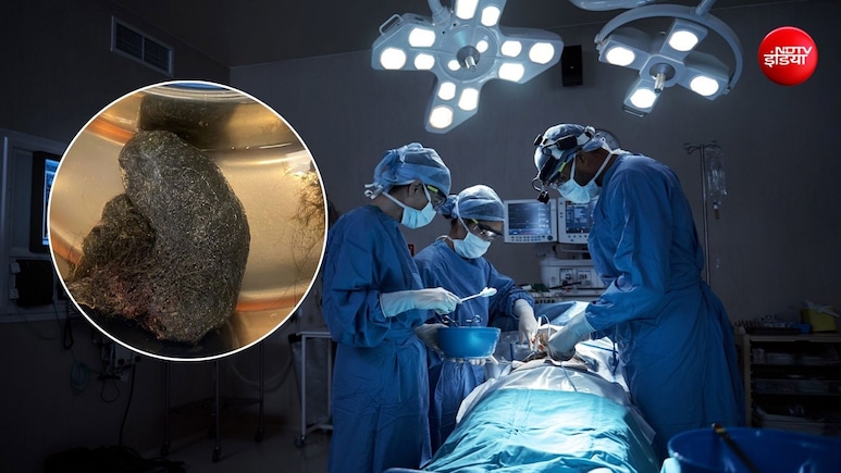 9 साल की बच्ची के पेट से निकला 1 किलो बालों का गुच्छा, रेपुंजेल सिंड्रोम ने डॉक्टर को किया हैरान