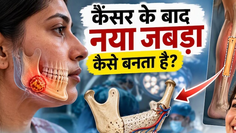 कैंसर में जबड़ा निकालना पड़े तो क्या दोबारा बन सकता है? पैर की हड्डी से ऐसे होता है Reconstruction