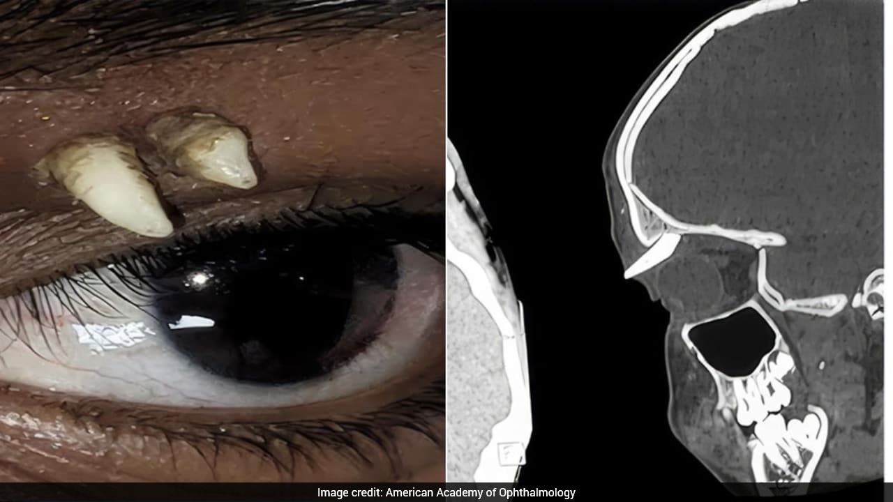 Indian Teen Is The Only Known Patient With Tooth Growing Inside His Eye Socket