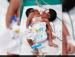 Conjoined Twins With 2 Heads, 1 Torso Die Week After Birth At Odisha Hospital