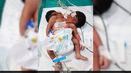 Conjoined Twins With 2 Heads, 1 Torso Die Week After Birth At Odisha Hospital
