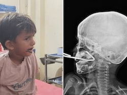 Iron Rod Pierces Gujarat Boy's Mouth As He Falls While Playing