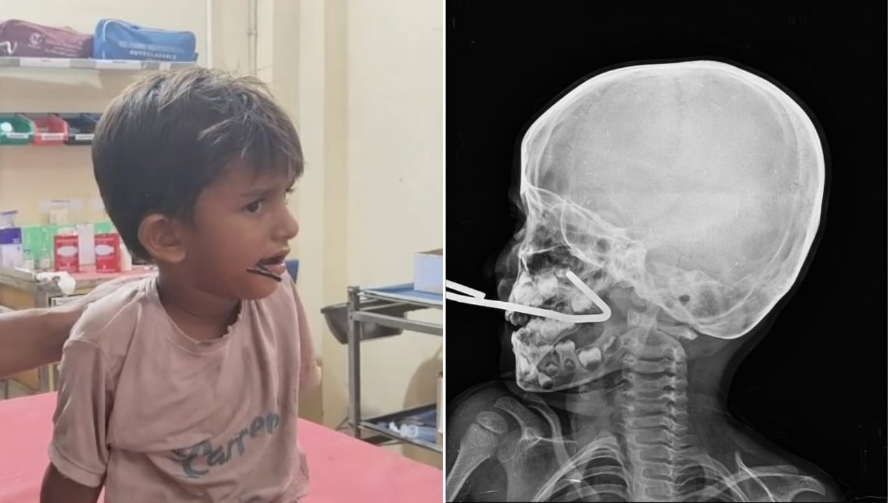 Iron Rod Pierces Gujarat Boy's Mouth As He Falls While Playing