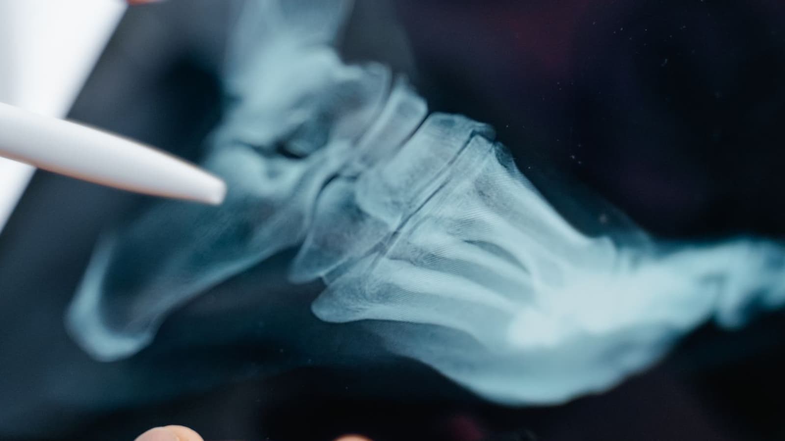 Experts Highlight Comprehensive Approach to Bone Health and Osteoporosis Prevention in India