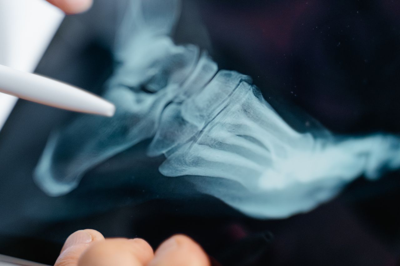 Getting a bone density scan early can help spot degeneration