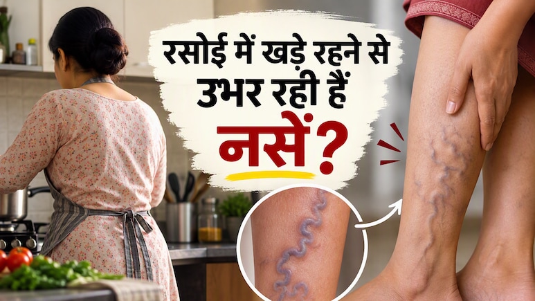 रसोई में खड़े खड़े सूज रहे हैं पैर? नीली नसों को सिर्फ दिनभर की थकान समझने की भूल मत कीजिए