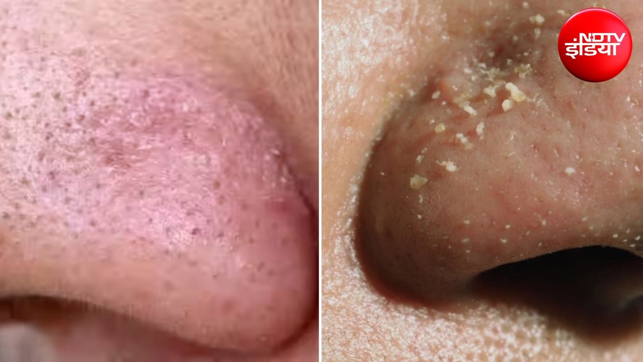 Whiteheads Removal: नाक-चेहरे के व्हाइटहेड्स से हो गए हैं परेशान? हटाने के लिए अपनाएं ये 3 तरीके, निखरेगी त्वचा