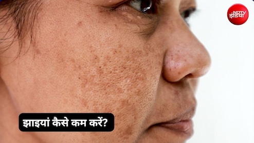 झाइयां कैसे कम करें? जानें जायफल, आलू और एलोवेरा के यूनानी घरेलू उपाय, दमक उठेगा चेहरा
