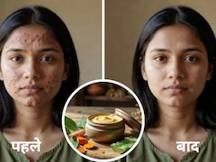 मुंहासों से परेशान हैं तो काम आएंगे ये 5 घरेलू पैक, नीम से एलोवेरा तक आजमाएं ये नुस्खे