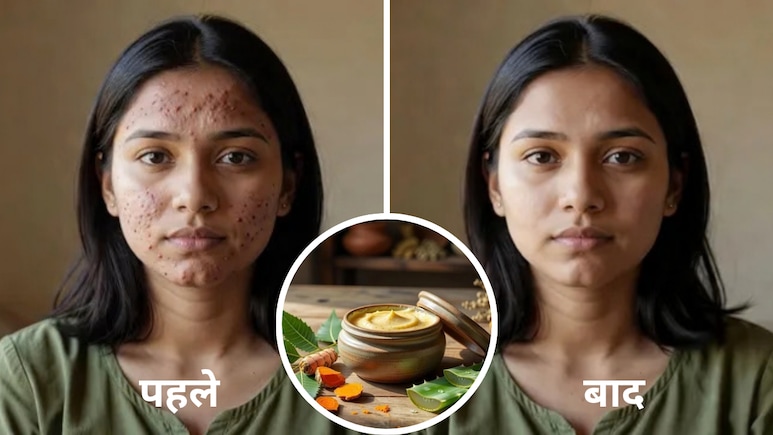मुंहासों से परेशान हैं तो काम आएंगे ये 5 घरेलू पैक, नीम से एलोवेरा तक आजमाएं ये नुस्खे