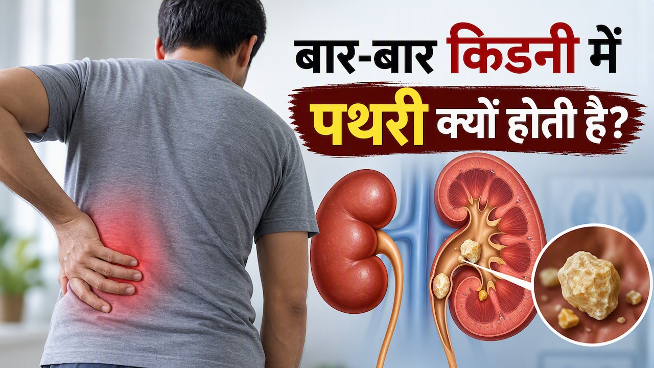 किडनी में बार-बार पथरी क्यों बनती है, एक इंसान कितनी बार सर्जरी करा सकता है, ब‍िना ऑपरेशन इलाज हो सकता है?