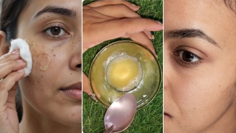 झाइयां कैसे दूर करें? पिगमेंटेशन खत्म करने के लिए 3 आसान घरेलू उपाय, एक्सपर्ट से जानिए