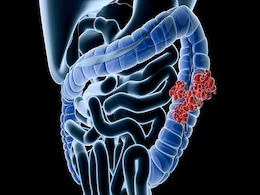 Colon Infection: क्या होता है कोलोन इंफेक्शन, इसके कारण और बचाव के तरीके Colon Infection: क्या होता है कोलोन इंफेक्शन, इसके कारण और बचाव के तरीके
