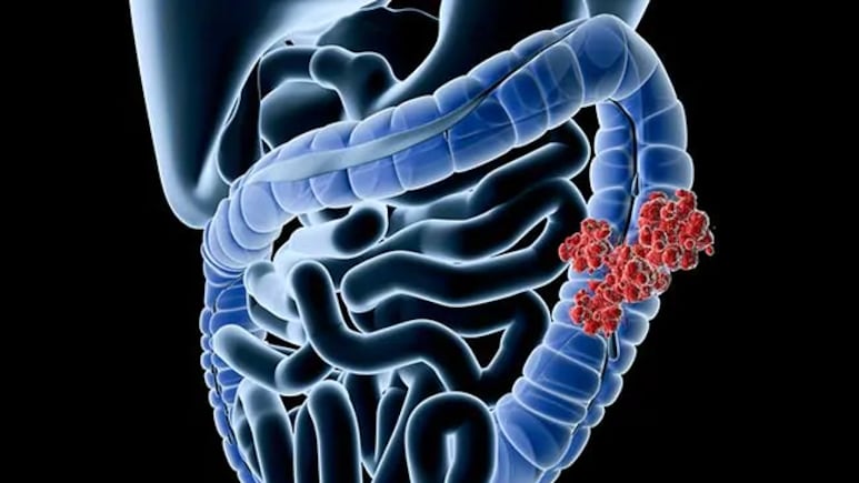 Compound In Long Pepper May Help Treat Colon Cancer, Odisha Scientists Confirm