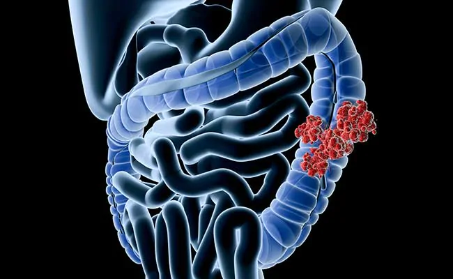 Compound In Long Pepper May Help Treat Colon Cancer, Odisha Scientists Confirm