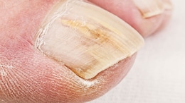 Tips To Treat Toenail Fungus At Home