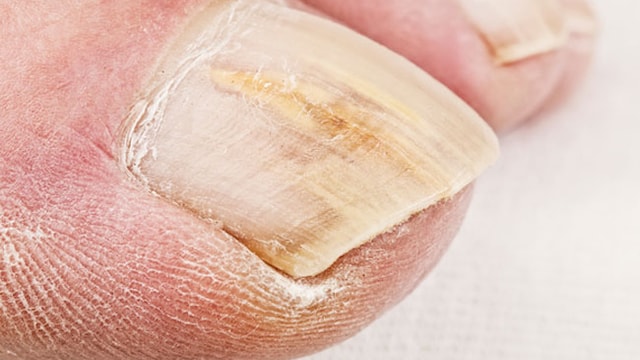 Tips To Treat Toenail Fungus At Home