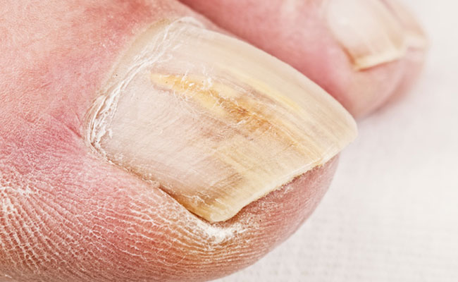 Tips To Treat Toenail Fungus At Home
