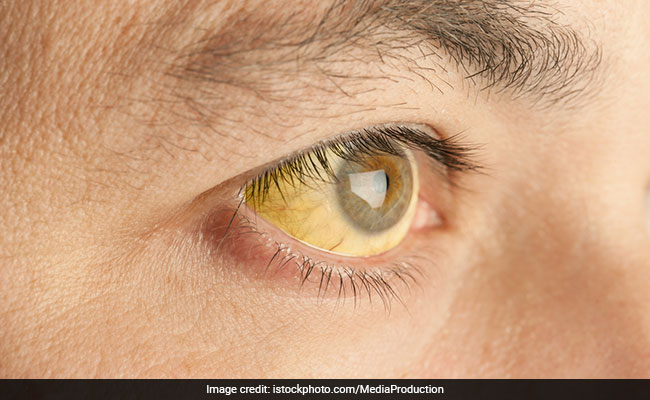 आंखों में ऐसा धब्बा 'पागलपन' का शुरुआती संकेत, ना करें इग्नोर