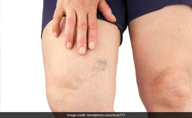 Swelling: खतरनाक हो सकती है शरीर की सूजन, जानें कारण और सूजन घटाने के घरेलू नुस्खे