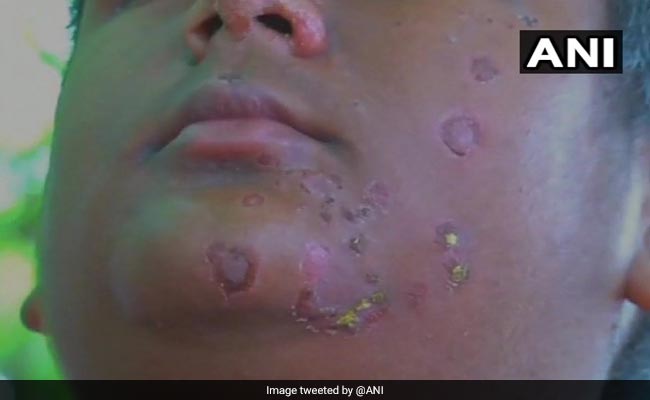 Autistic Boy Allegedly Tortured With Burning Cigarettes In Coimbatore