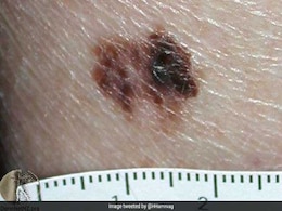 Scientists Develop World's First Melanoma Blood Test Scientists Develop World's First Melanoma Blood Test