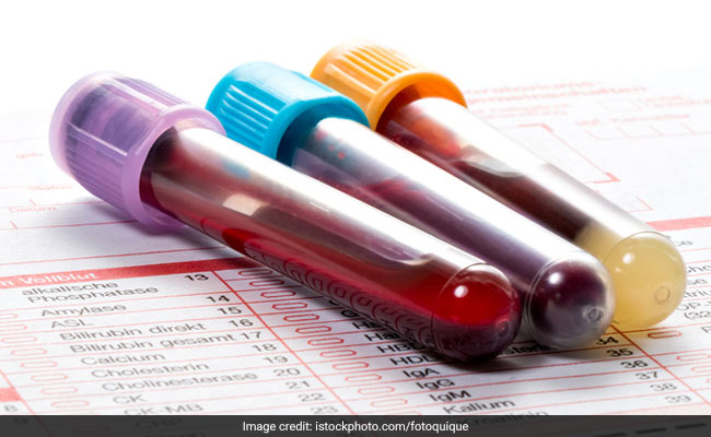Nutritionist advises against panicking over cholesterol reports that only present the total cholesterol