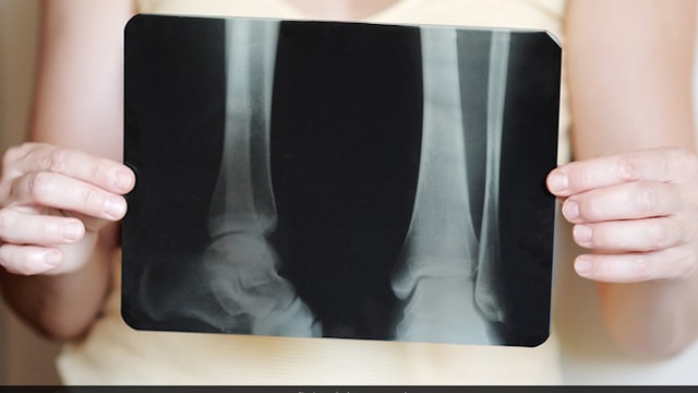 Bones and Joint Day: 'Prevention of deformity in degenerative disease' is the theme for the year 2021