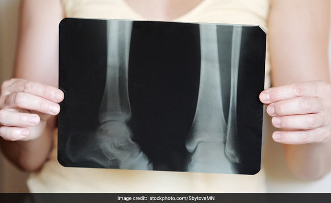 Bones and Joint Day: 'Prevention of deformity in degenerative disease' is the theme for the year 2021