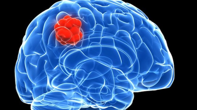 World Brain Tumour Day: Strong headaches, blurred vision can be a sign of brain tumour
