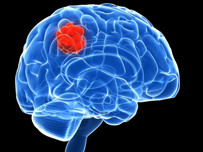 World Brain Tumour Day: Strong headaches, blurred vision can be a sign of brain tumour
