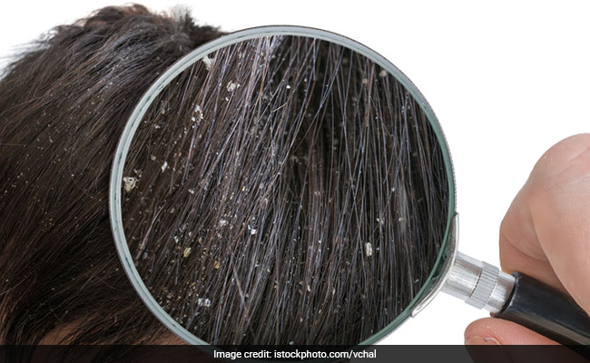 Got A Case Of Dandruff And Itchy Scalp? All You Need Is Ginger To Control It!