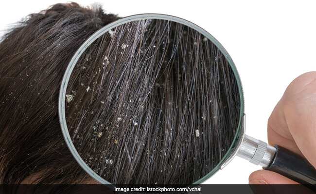 Hair Care Tips: बेकिंग सोडा का इन तीन तरीकों से करें इस्तेमाल जड़ से खत्म हो जाएगा डैंड्रफ!
