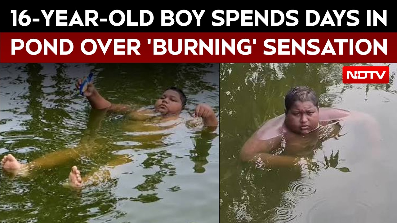 Bengal Teen Stays In Ponds, Says He Feels 'Burning Sensation' Outside Water