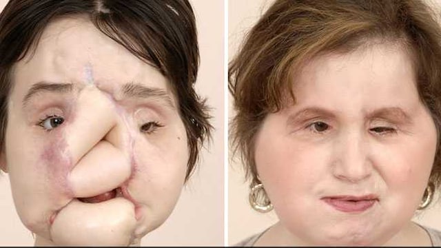 Katie's disfigured is the outcome of her suicide attempt when she was 18