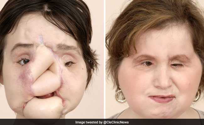 Katie's disfigured is the outcome of her suicide attempt when she was 18