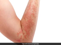 Home Remedies: एलर्जी से शरीर पर लाल चकत्ते निकल आए हैं, तो इन 5 क्विक और इफेक्टिव घरेलू नुस्खों से पाएं जल्द राहत Home Remedies: एलर्जी से शरीर पर लाल चकत्ते निकल आए हैं, तो इन 5 क्विक और इफेक्टिव घरेलू नुस्खों से पाएं जल्द राहत