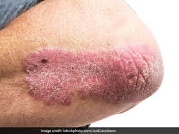 सोरायसिस कोई एलर्जी नहीं, बल्कि इम्यून सिस्टम की गड़बड़ी, जानें राहत पाने के आयुर्वेदिक उपाय सोरायसिस कोई एलर्जी नहीं, बल्कि इम्यून सिस्टम की गड़बड़ी, जानें राहत पाने के आयुर्वेदिक उपाय